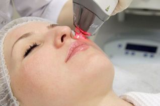 Processo di ringiovanimento della pelle del viso con laser frazionato