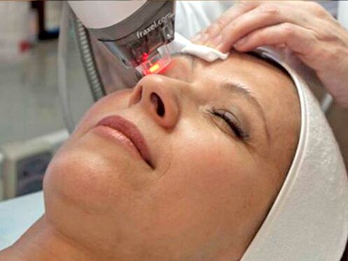 ringiovanimento laser della pelle intorno agli occhi