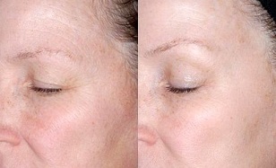 ringiovanimento della pelle intorno agli occhi prima e dopo le foto