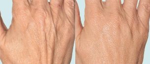 Pelle delle mani prima e dopo la terapia frazionata
