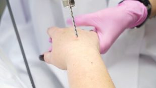 Ringiovanimento laser della pelle delle mani