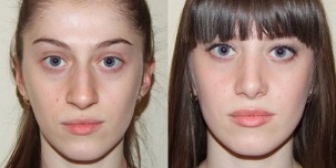 prima e dopo il ringiovanimento della pelle al plasma